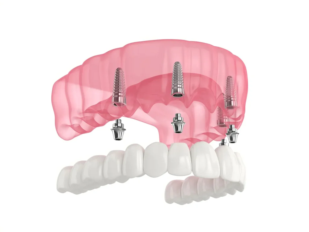 All-on-4 vs. All-on-6: Which Full Arch Implant